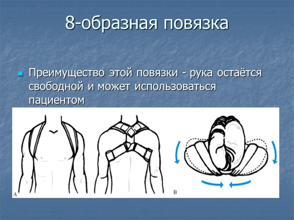 8-образная повязка Преимущество этой повязки - рука остаётся свободной и может использоваться пациентом